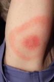 A circular ‘bullseye’ rash at the site of a tick bite is often the first sign of Lyme disease infection.